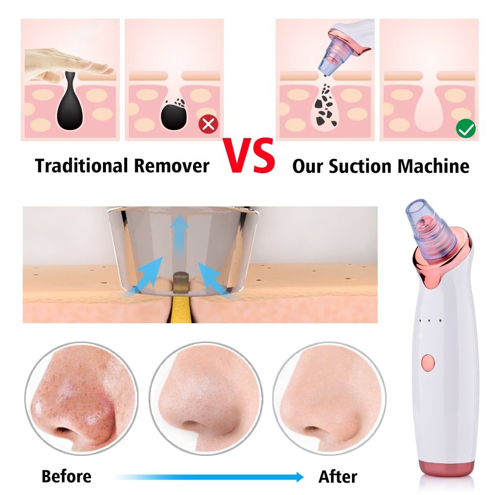Electric Blackhead Remover | Blackhead Suction Vacuum | Terni Beauty